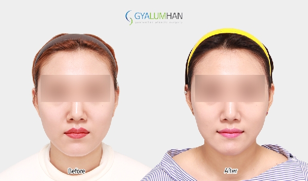 Facial liposuction 이미지