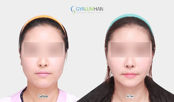 Facial liposuction 이미지